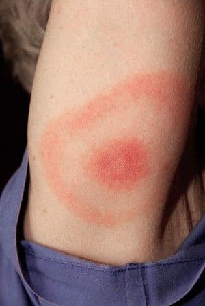 1024px-erythema_migrans_-_erythematous_rash_in_lyme_disease_-_phil_9875.jpg