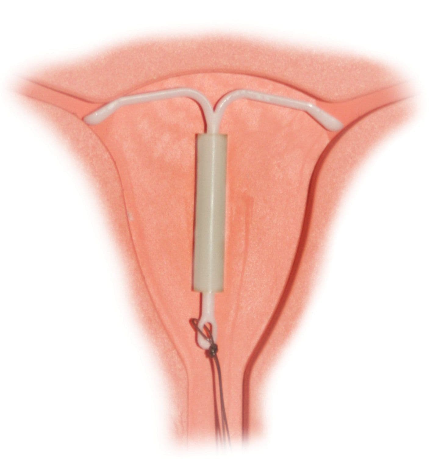mirena_intrauterine_system.jpg